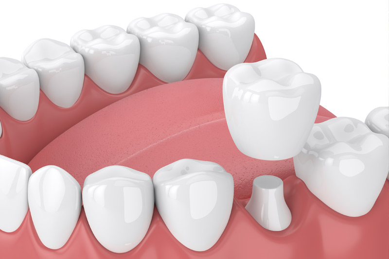 Dental Crowns in Meriden