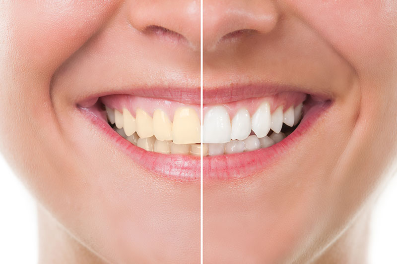 Teeth Whitening in Meriden