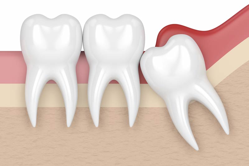Wisdom Tooth Removal in Meriden